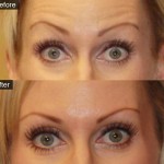botox1